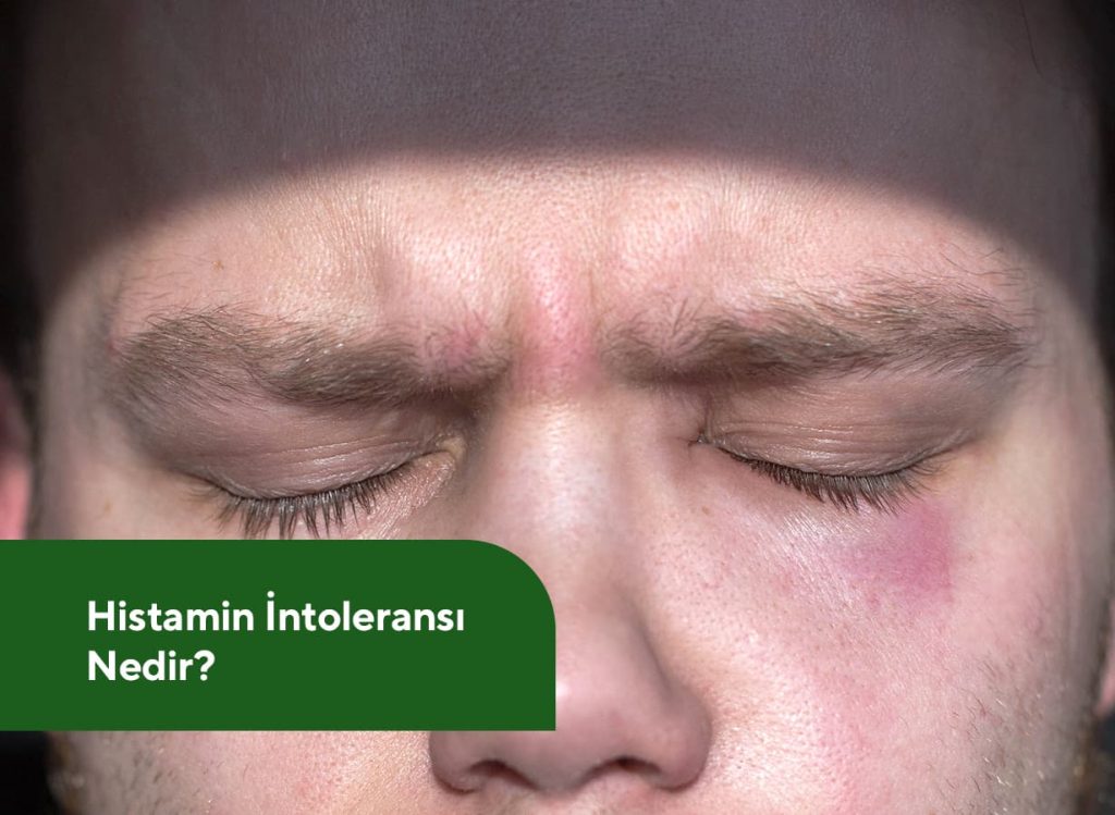 histamin-ntolerans-nedir-m-cteba-g-nd-z